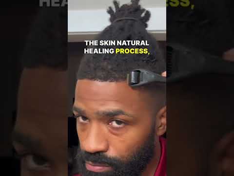 Revitalize Your Mane: Microneedling for Hair Growth Success