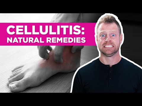 Revolutionary Treatment for Cellulitis: Heal Faster Today