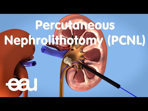 Revolutionizing Kidney Stone Treatment with Nephrolithotomy Technology