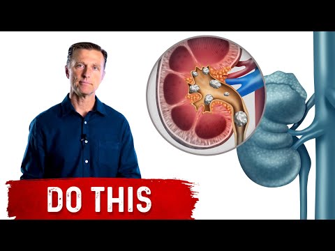 Nature's Remedy for Kidney Stones: Heal Your Way to Health