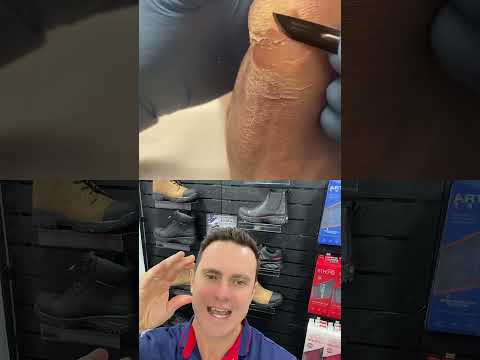 Transform Your Feet: Innovative Solutions for Cracked Skin