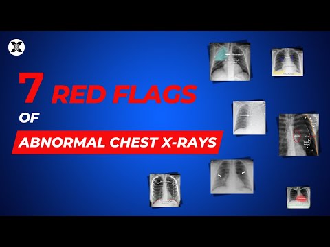 Unlocking Health Insights: Normal Lung X-Rays Explained
