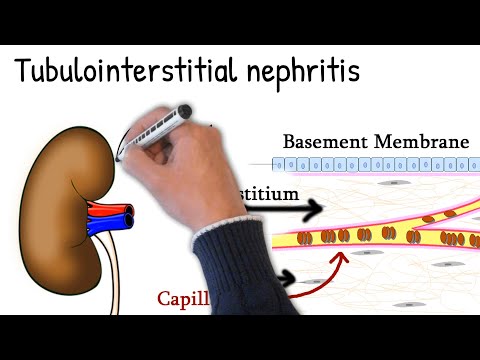 Innovative Solutions for Tubulo Interstitial Nephritis Care