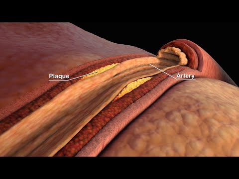 Understand Your Non HDL Cholesterol for Better Health Tech