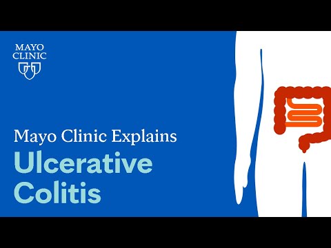 Understanding Colitis: Key Types and Their Impact on Health Understanding Colitis: Key Types and Their Impact on Health