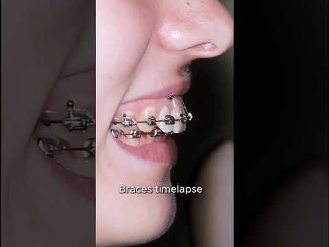 Revolutionary Braces to Perfect Your Overbite Smile