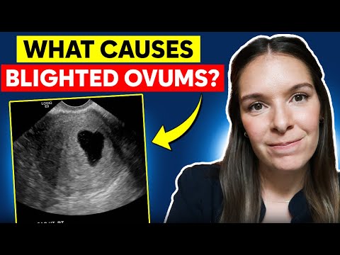 Navigating Anembryonic Pregnancy with Tech Innovations