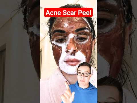 Revitalize Your Skin with Advanced Hand Peeling Solutions