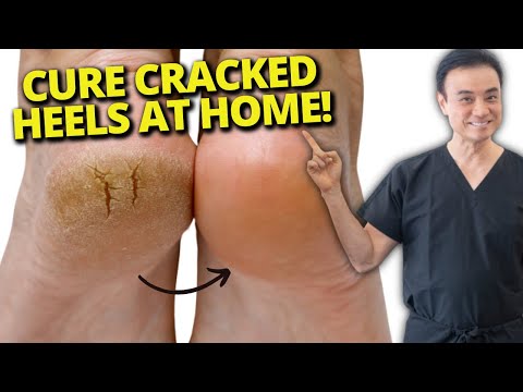 Smooth Steps: Innovative Solutions for Cracked Heel Care