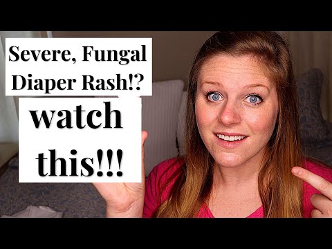 Nurture with Tech: Defeat Severe Diaper Rash Today