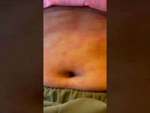 Banishing Blanching Rash: Tech Solutions for Skin Relief