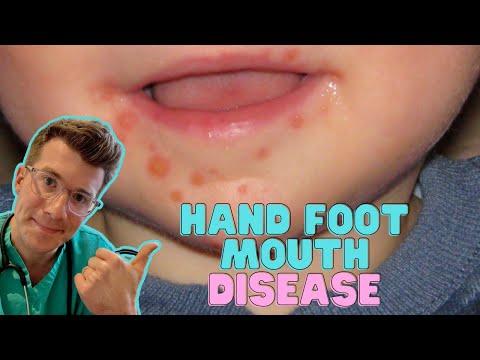 Tongue Trouble: Tackling Hand Foot and Mouth Disease Today