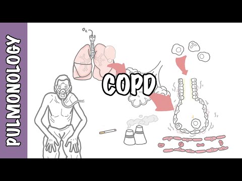 Elevate COPD Care with Advanced Exacerbation Treatments