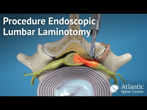 Revolutionizing Spine Surgery with Laminotomy Techniques