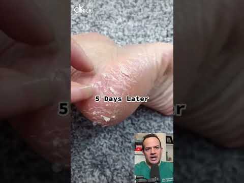 Revitalize Your Feet with Advanced Dead Skin Removal Tech