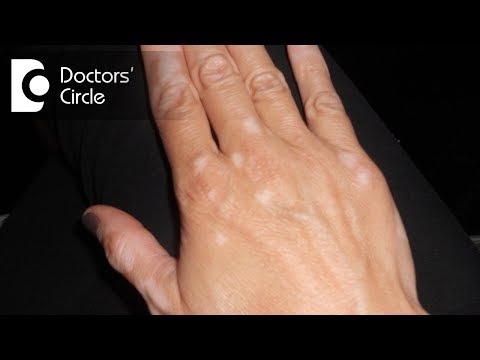 Uncover Solutions for Itchy White Spots on Your Skin