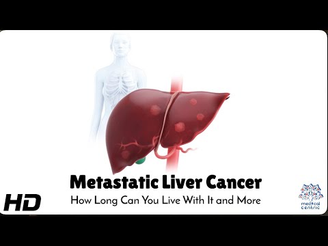 Innovative Solutions for Liver Metastases Management