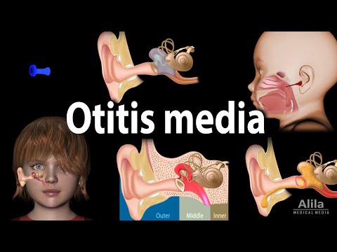 Revolutionizing Care for Suppurative Otitis Media Today
