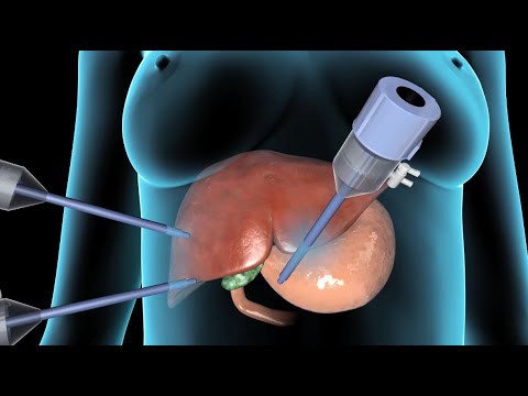 Revolutionizing Gallbladder Surgery with Lap Cholecystectomy Tech