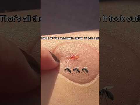 Say Goodbye to Bug Bite Swelling with Smart Solutions