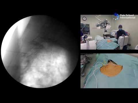 Sympathectomy: A Path to Pain Relief and Improved Health