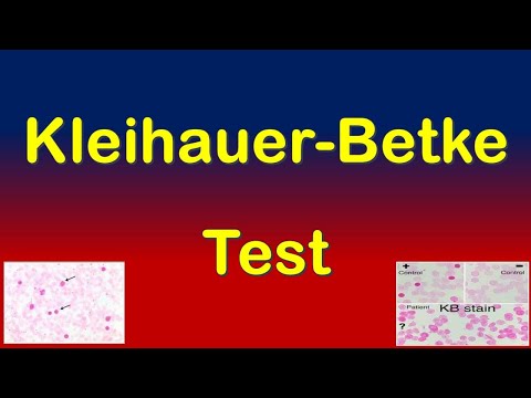 Kleihauer Betke Test Revolutionizes Fetal Medicine Insights