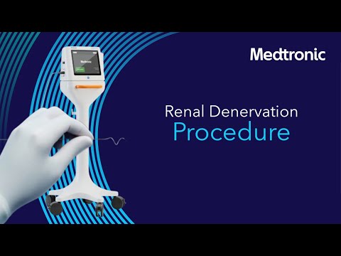 Revolutionizing Hypertension Treatment with Renal Denervation Technology