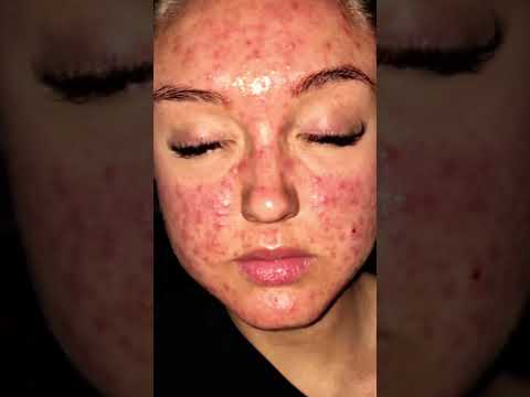 Retinyl Palmitate: The Skincare Innovation You Need Now